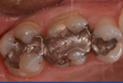 dente devitalizzato2